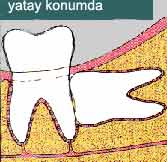 Yatay 20lik diş